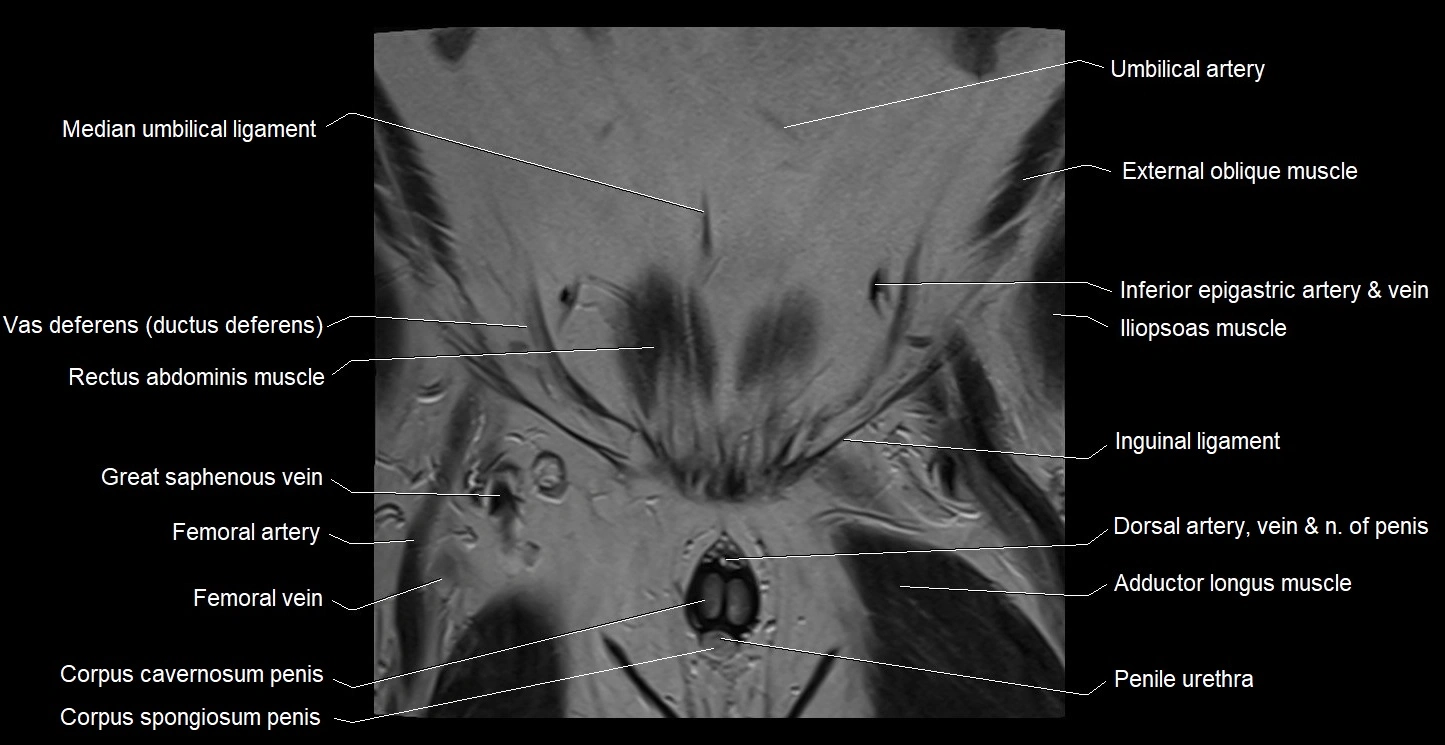 MRI coronal cross sectional anatomy male pelvis image 6.webp